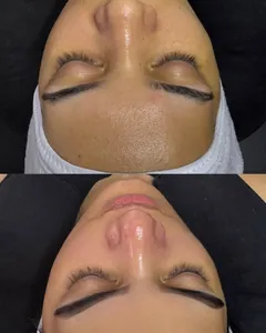 Antes e depois da limpeza de pele profunda, com a cliente deitada.